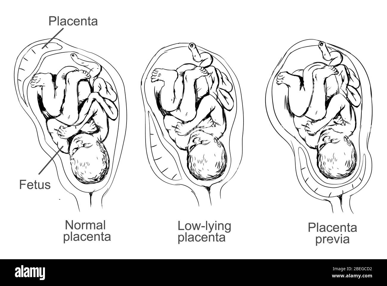 Illustration of placenta previa, a condition in which the placenta lies low in the uterus and covers the cervix, causing pregnancy complications. Stock Photo