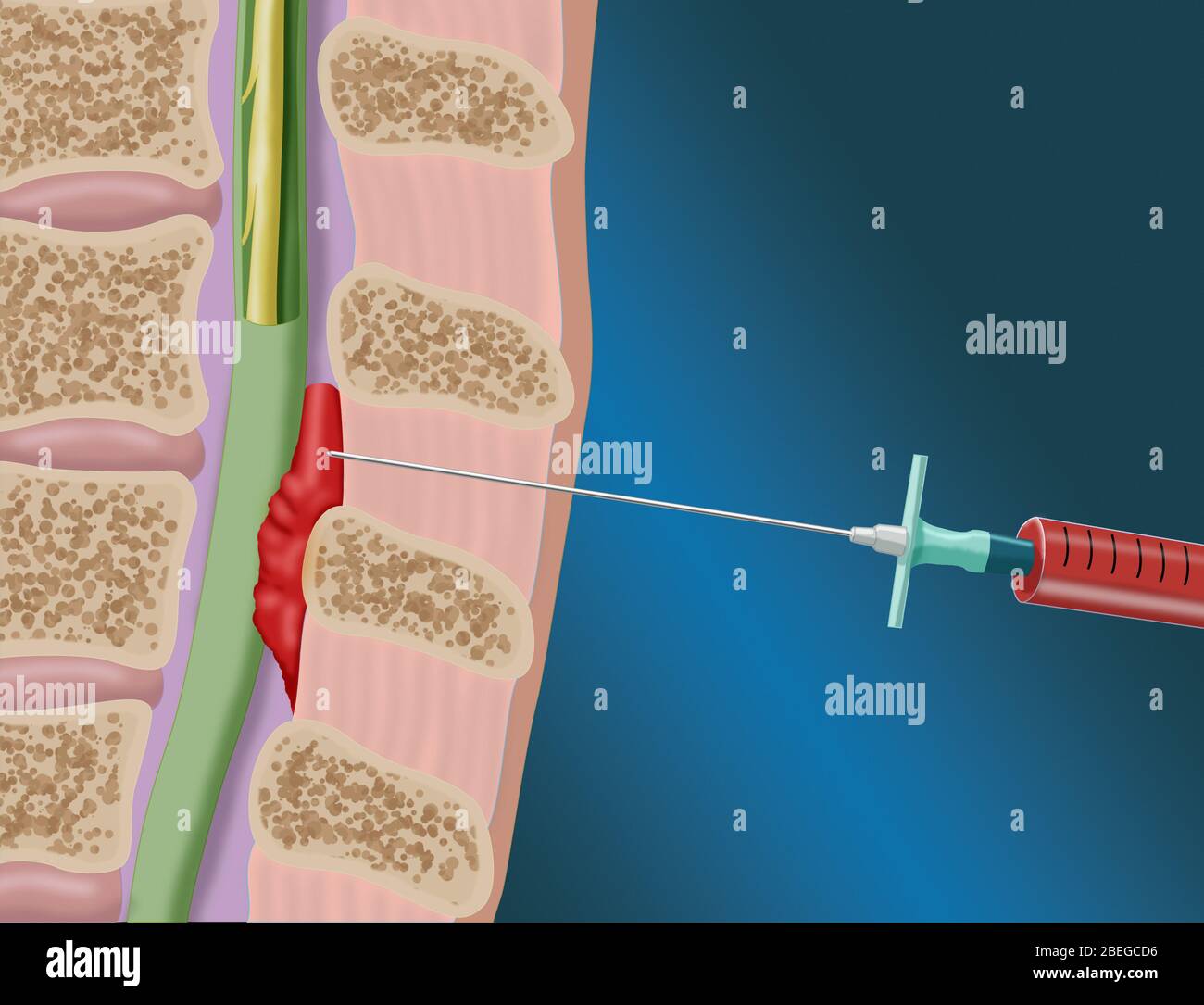 Where Does Epidural Needle Go In