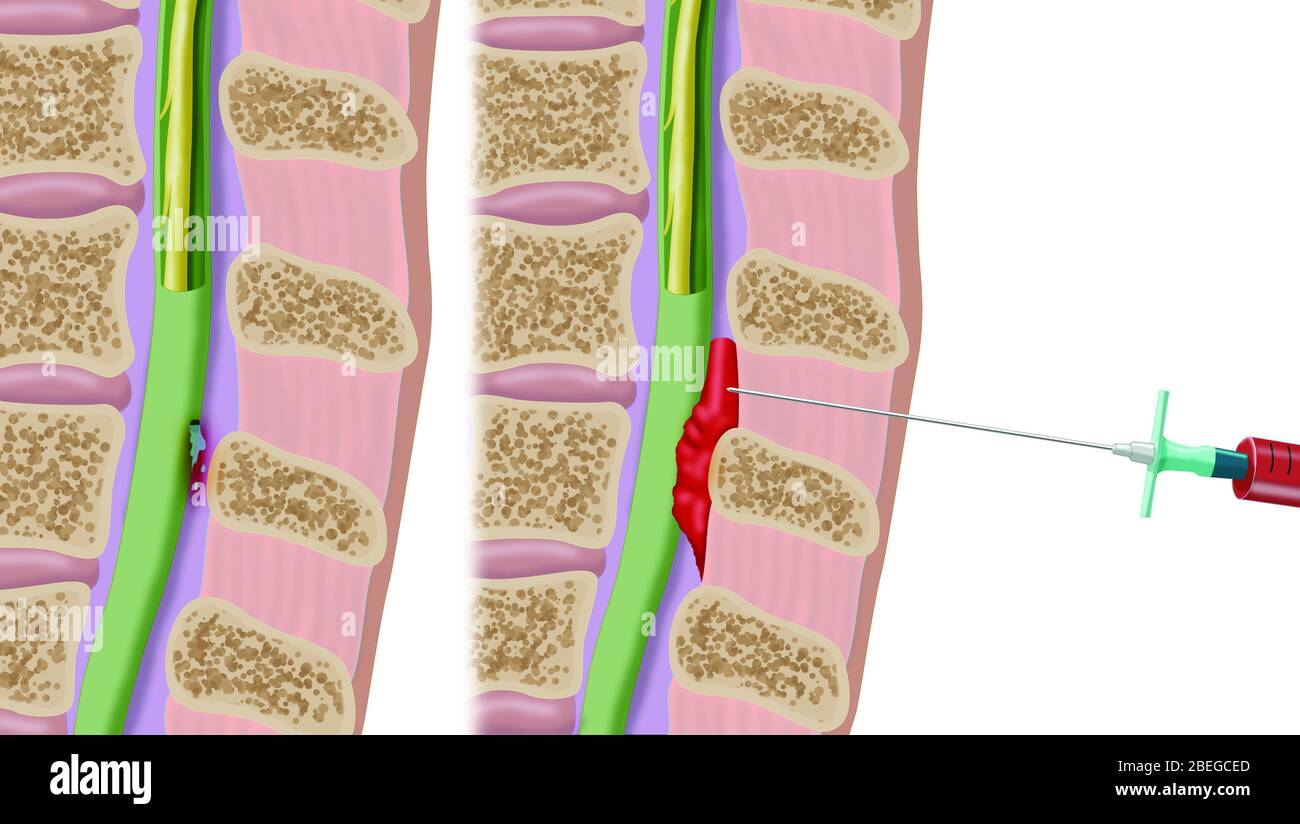 Epidural Blood Patch Procedure, Illustration Stock Photo Alamy