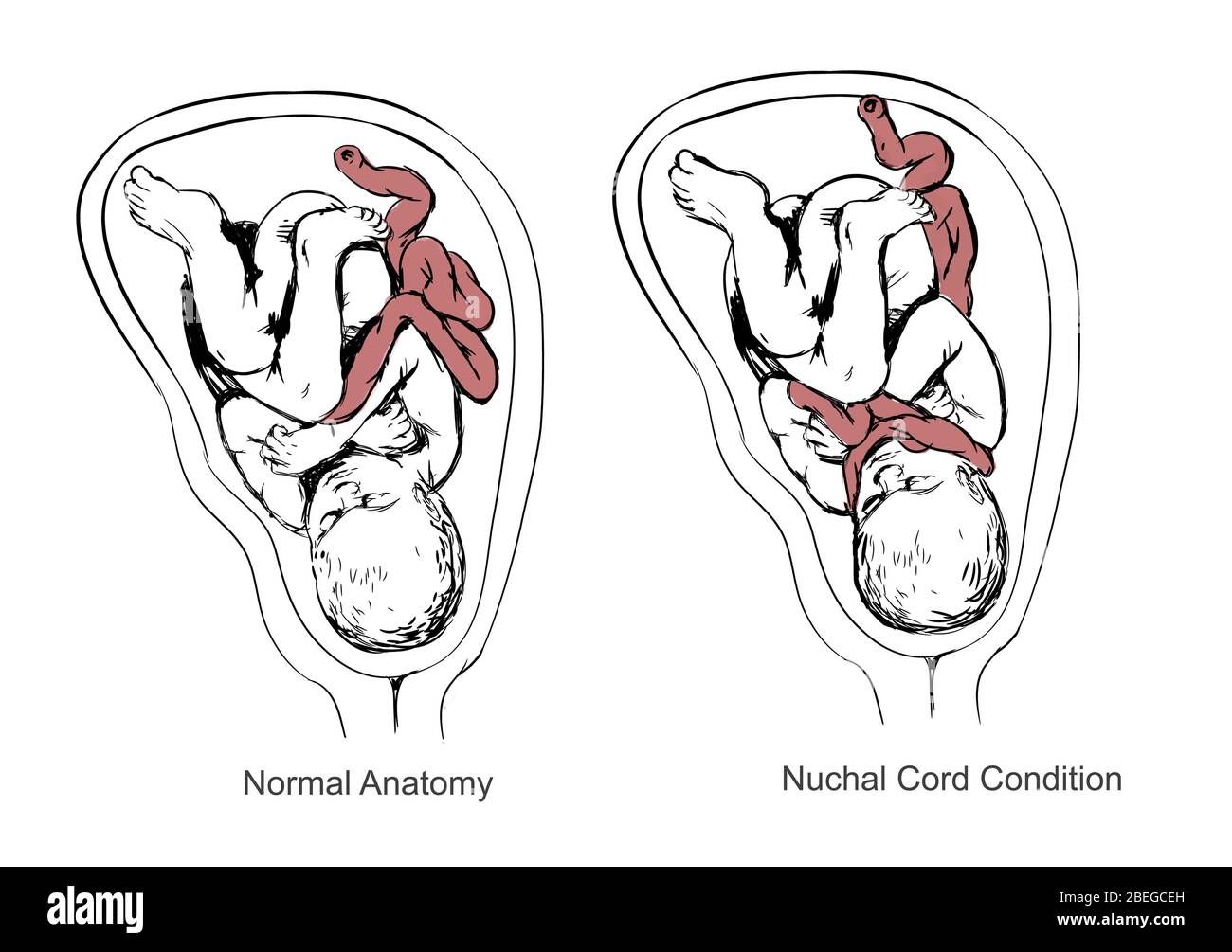 Nuchal Cord and Birth Asphyxia, Illustration Stock Photo