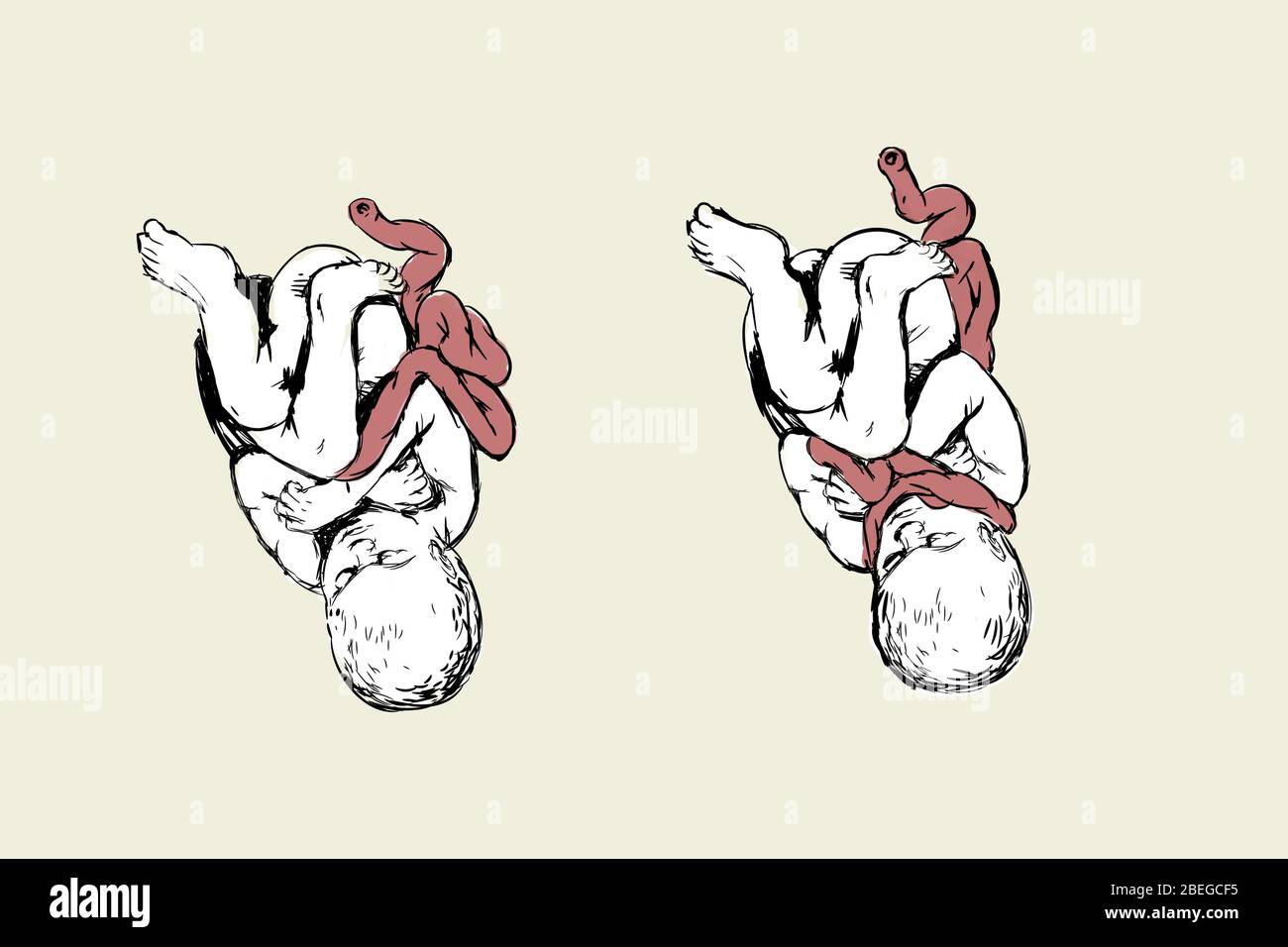 Nuchal Cord and Birth Asphyxia, Illustration Stock Photo