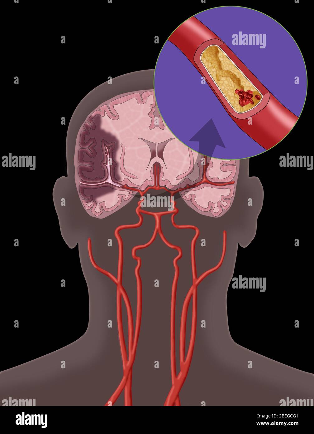 Ischemic Stroke, Illustration Stock Photo