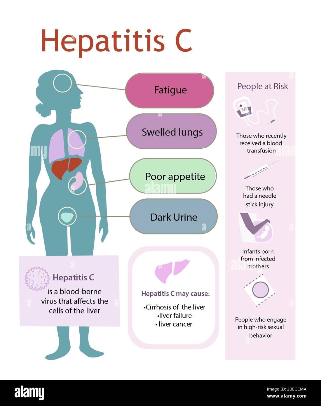 Hepatitis C - diagram indicating the effects of Hepatitis C, description of the illness and other facts. Stock Photo
