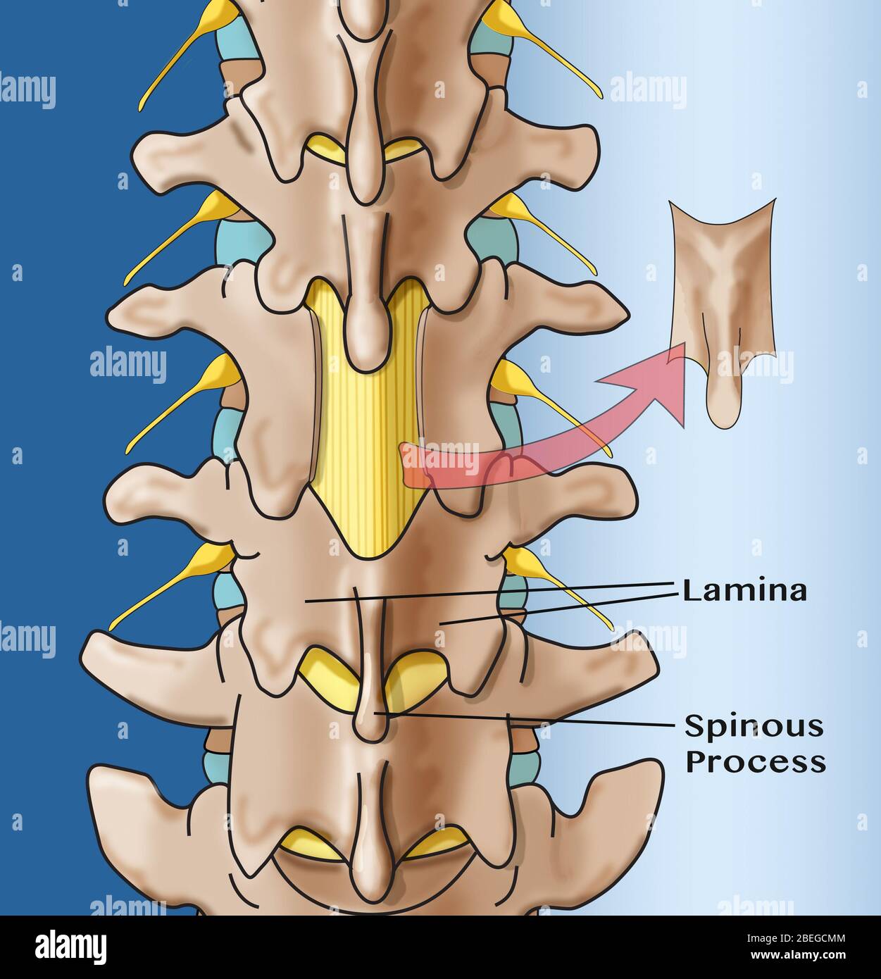 Laminectomy hires stock photography and images Alamy