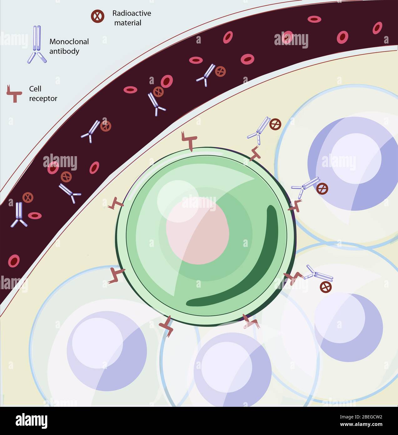 Illustration showing how radioimmunotherapy (RIT) works to kill tumors in the body. RIT uses engineered monoclonal antibodies paired with radioactive material.  These are injected into the bloodstream where they bind to cancer cells to deliver radiation directly to the tumor. Stock Photo