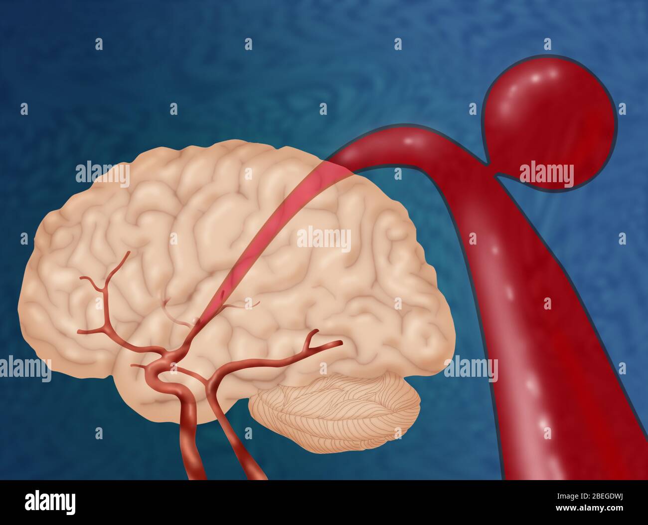 Brain Aneurysm Stock Photo