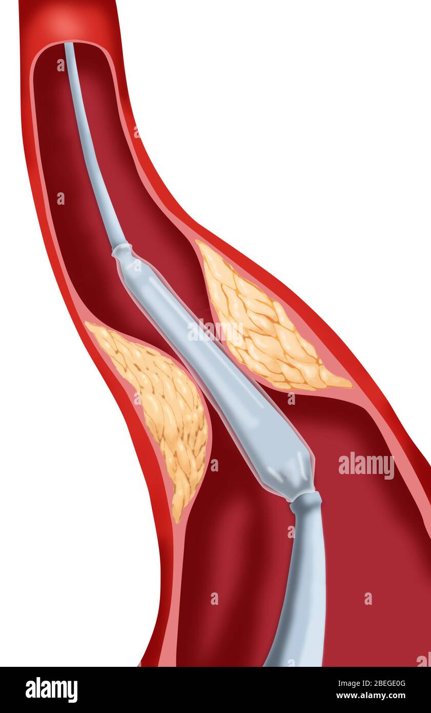 Balloon Angioplasty, 1 of 4 Stock Photo Alamy