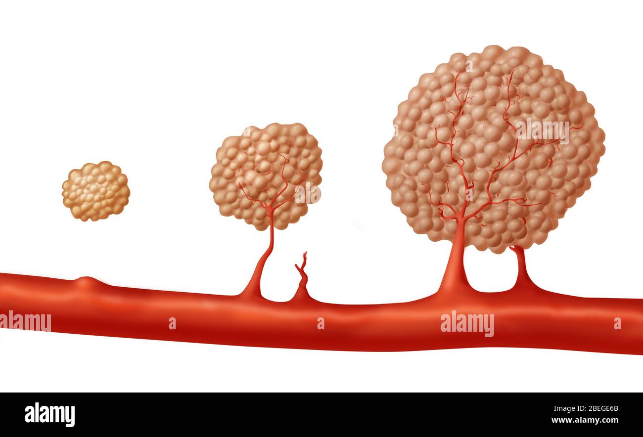 Angiogenesis hi-res stock photography and images - Alamy