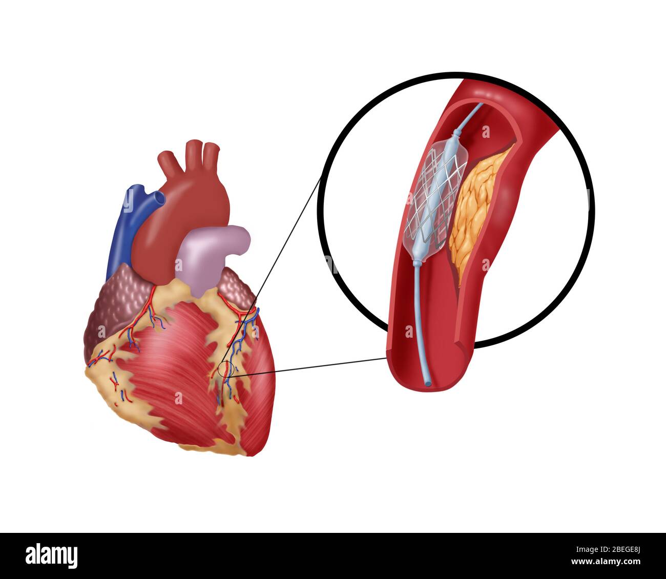 Angioplasty with Stenting, 2 of 4 Stock Photo - Alamy