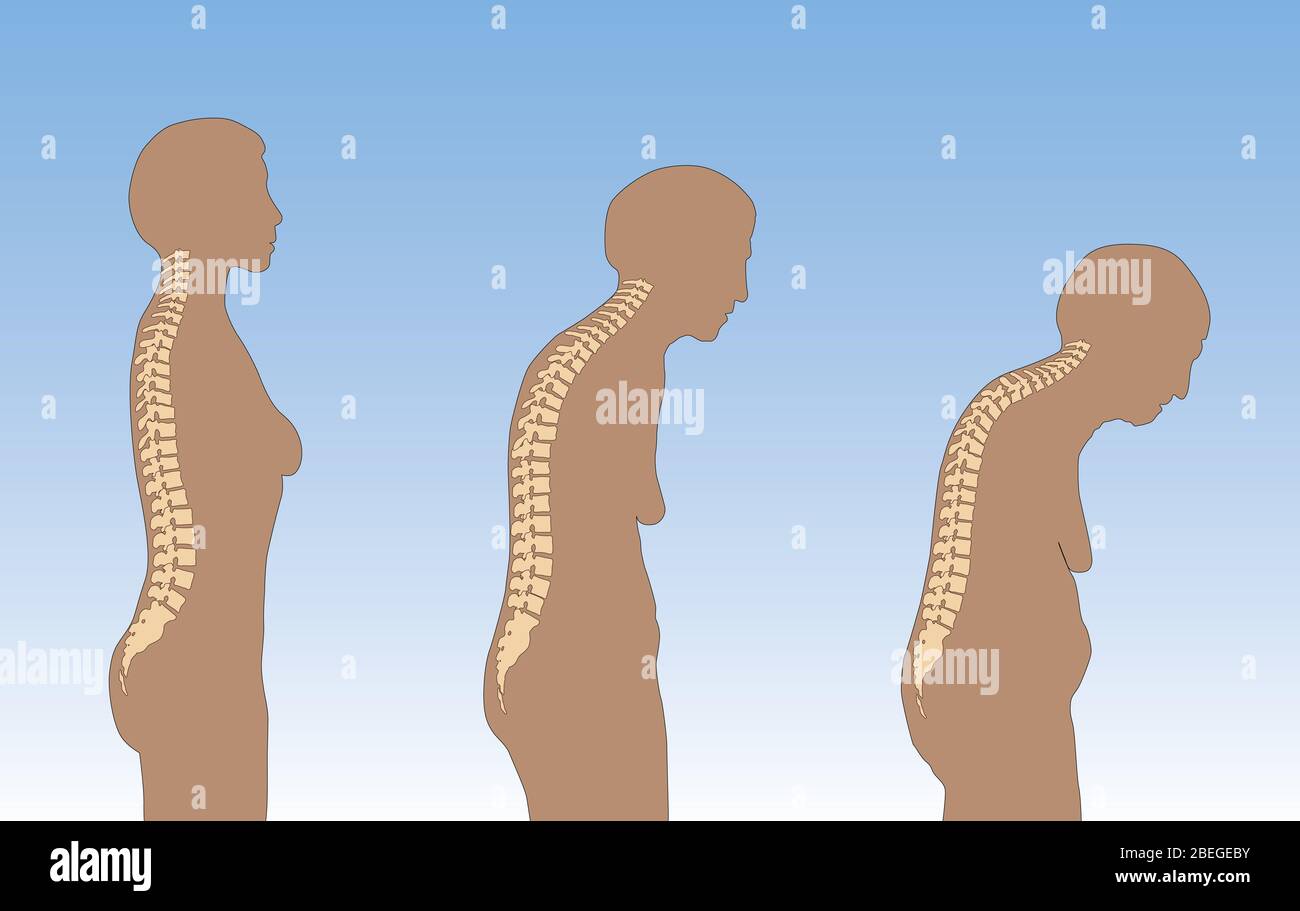 Dowagers hump hires stock photography and images Alamy