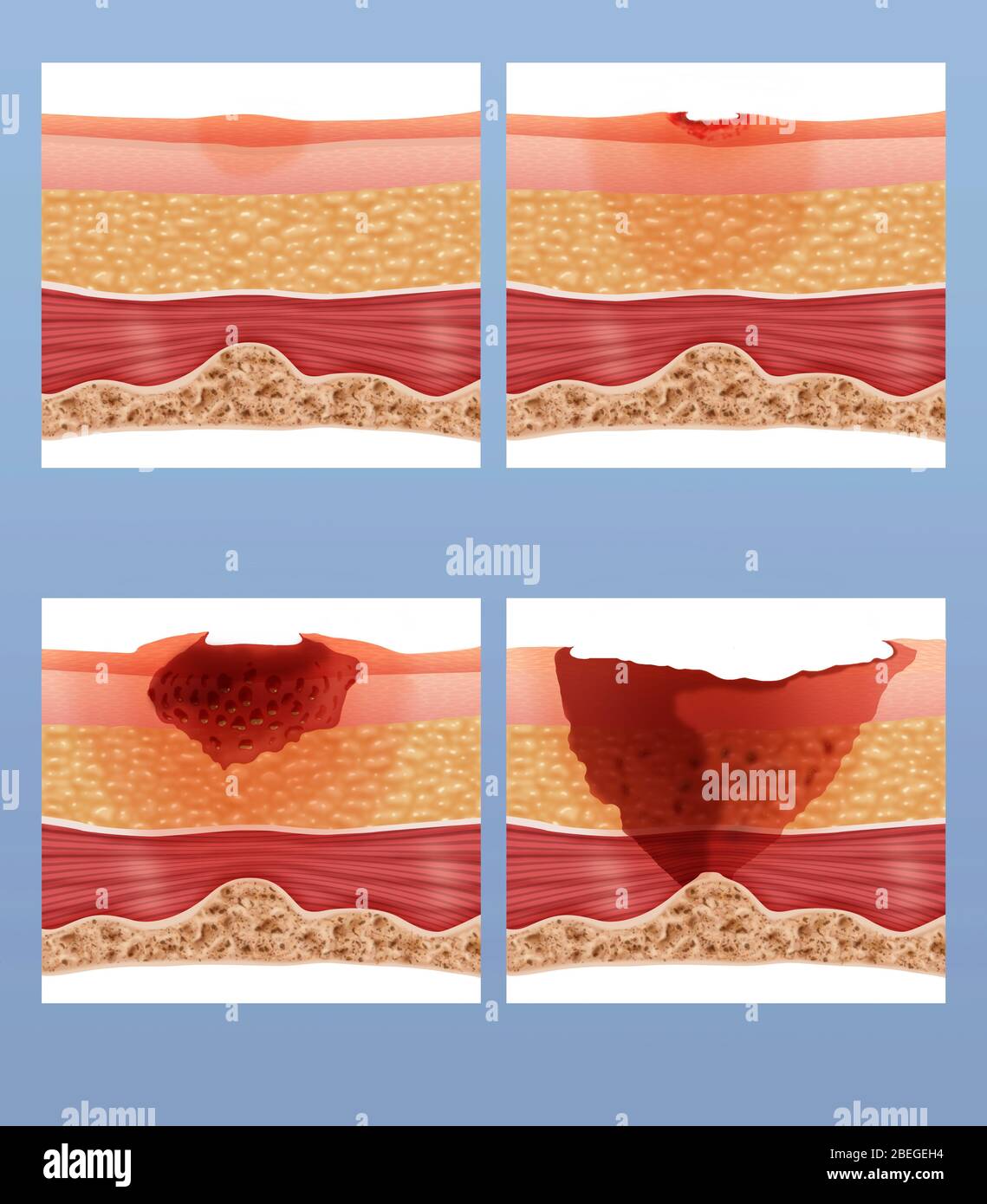 Bed sores hires stock photography and images Alamy