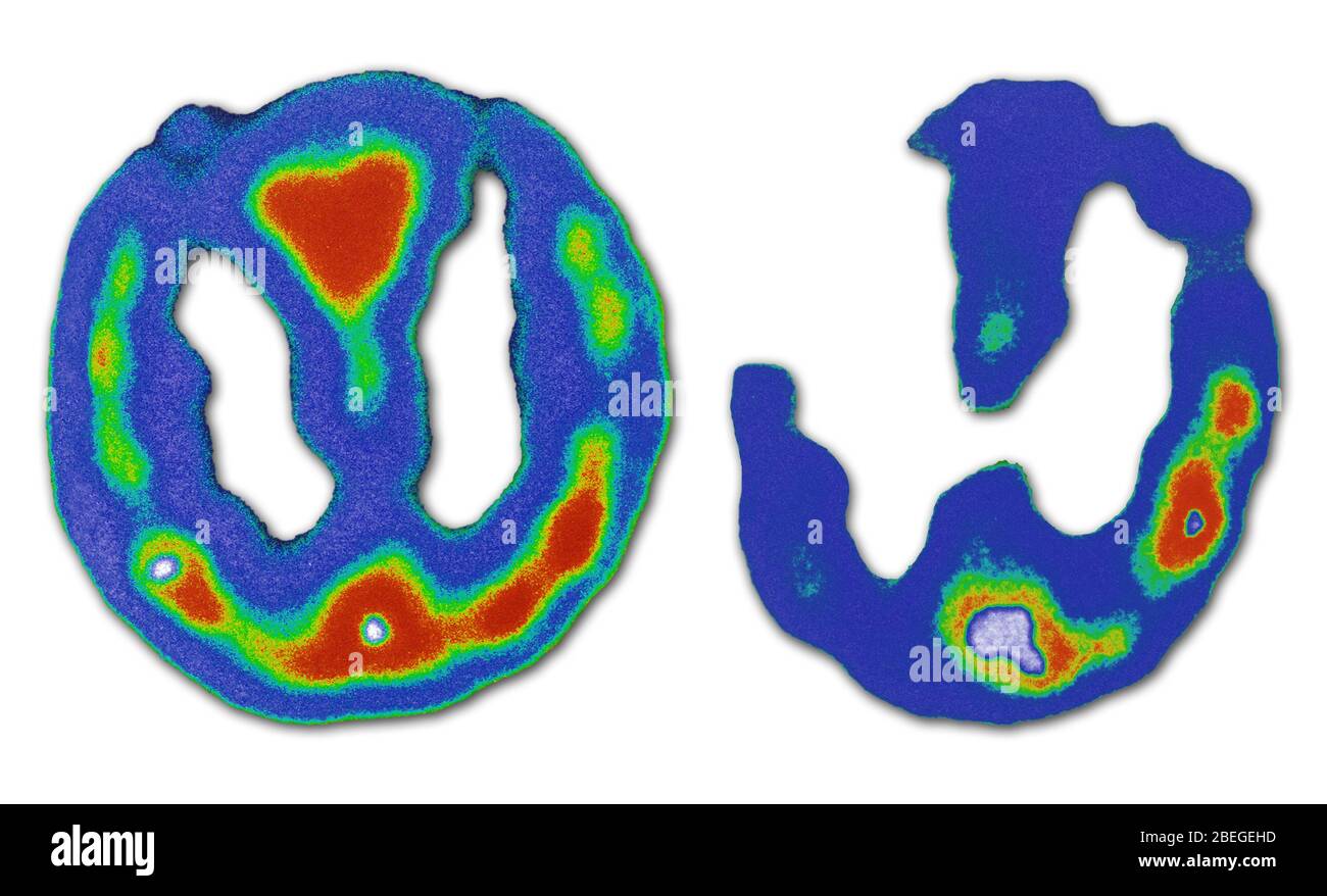 Brain Scans (Normal and Alzheimer's) Stock Photo
