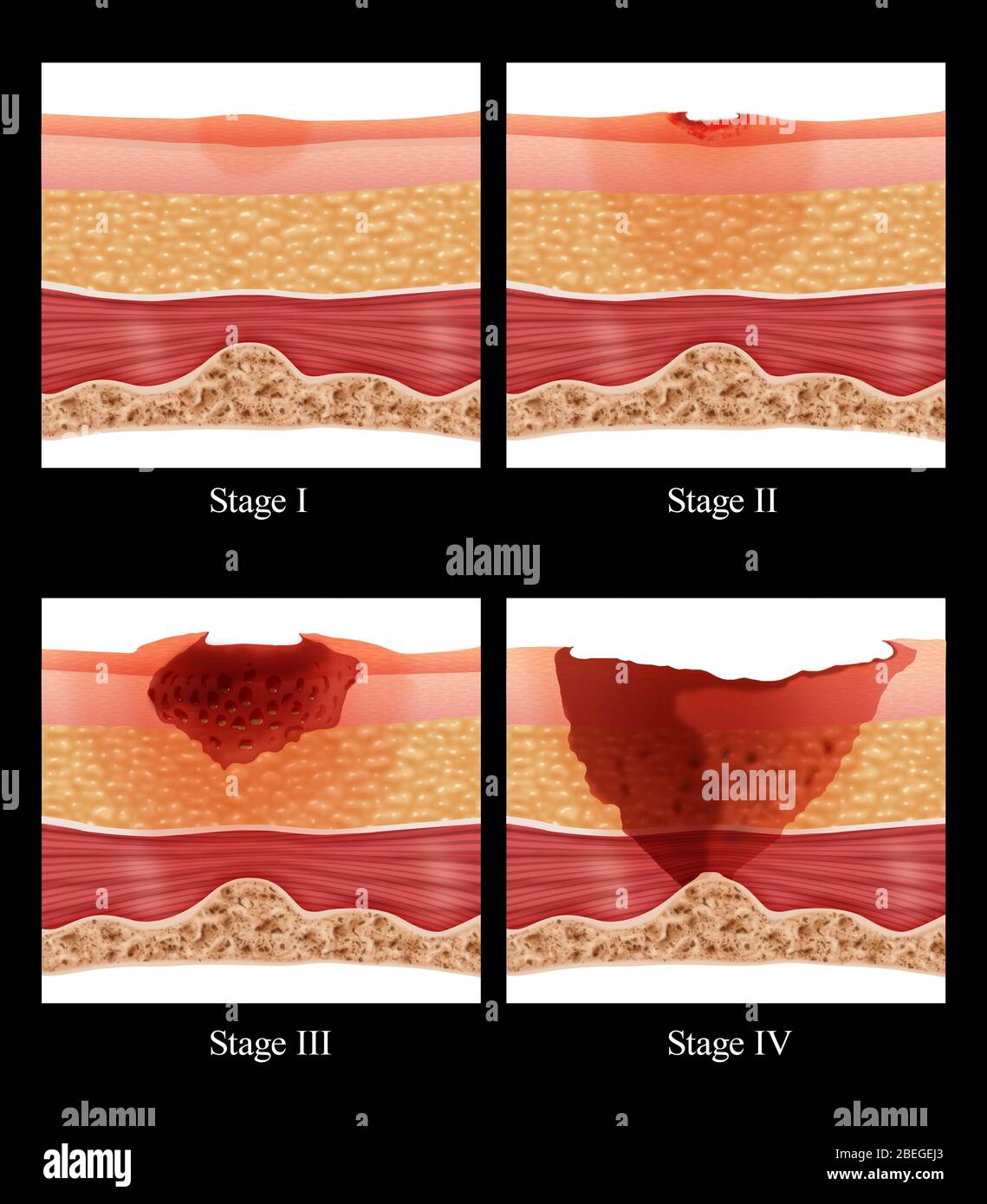 Bed Sores Stock Photo
