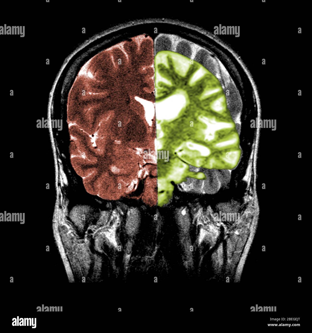 Normal Brain Vs Normal and Alzheimer's Brain MRIs Stock Photo - Alamy