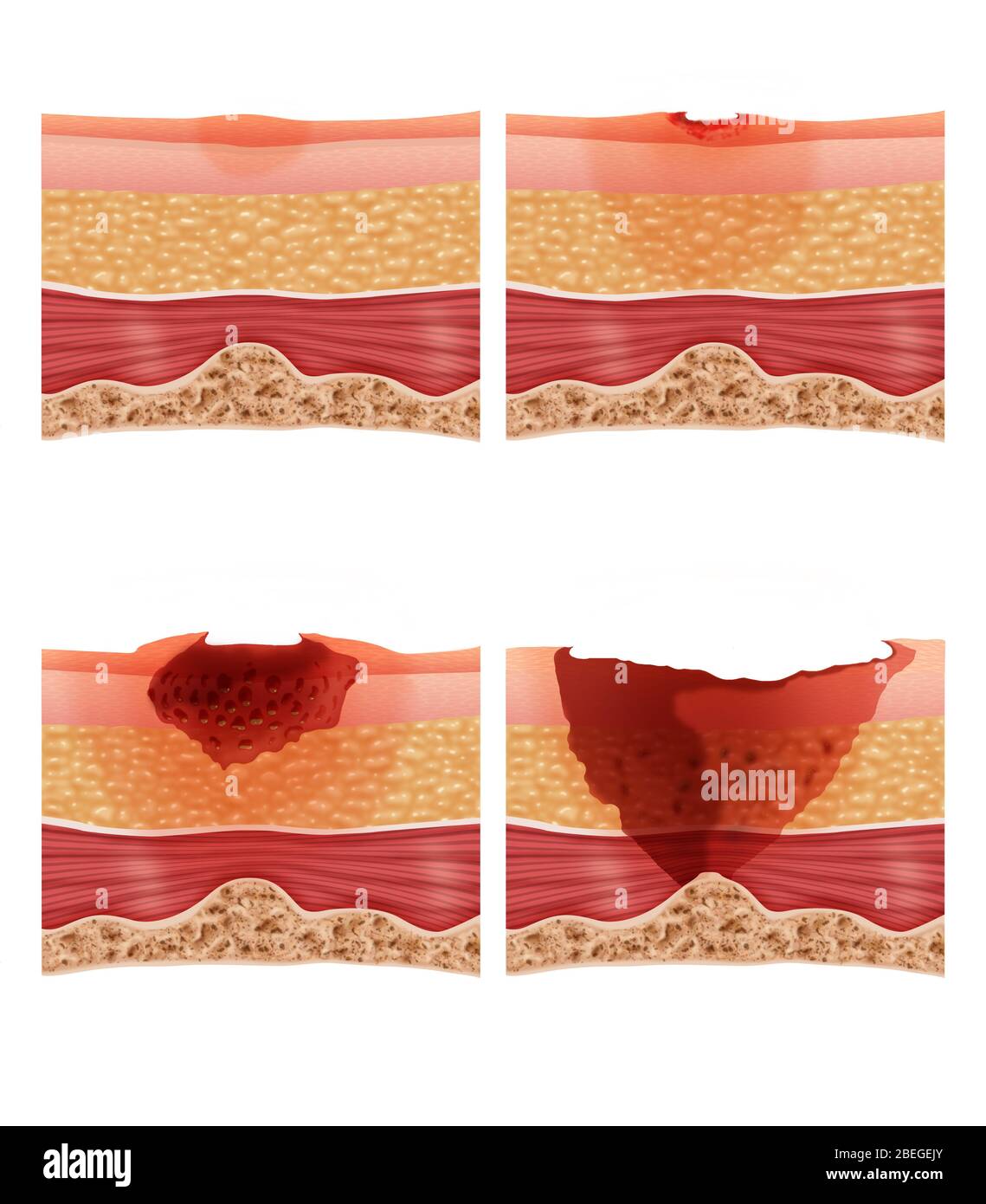 Bed sores cut out stock images pictures alamy