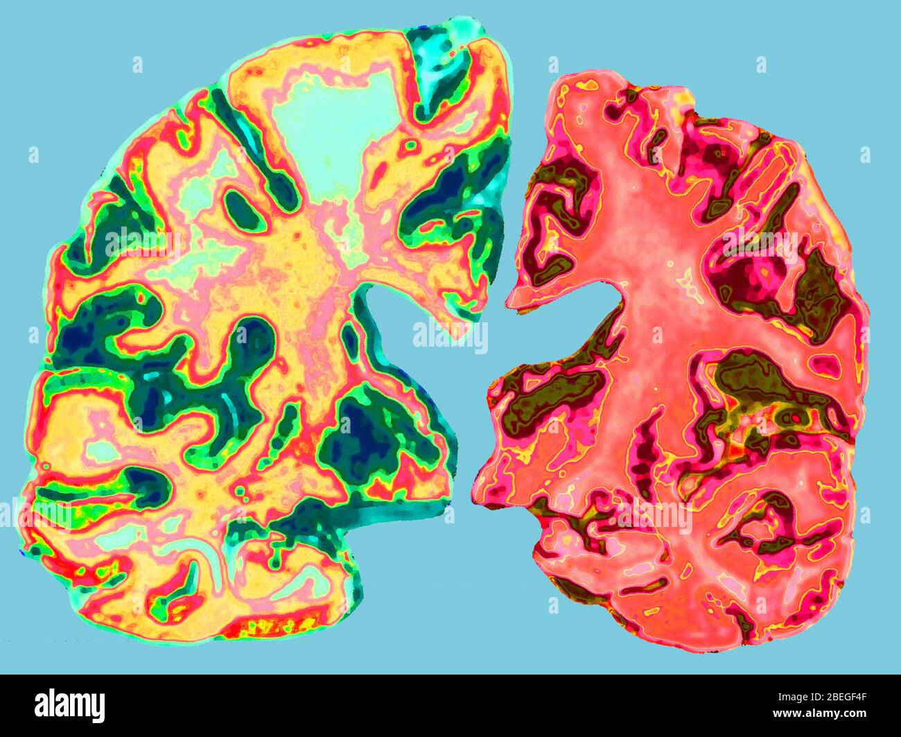 Normal and alzheimer disease brain hi-res stock photography and images ...