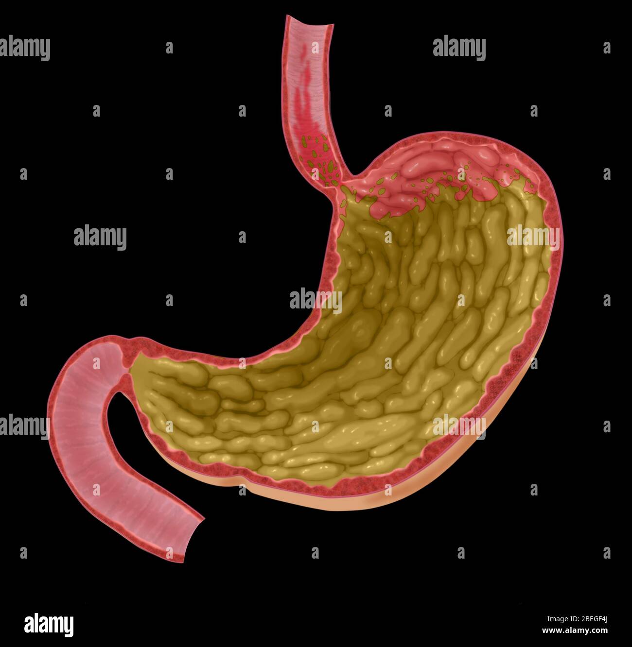Illustration of Acid Reflux Stock Photo Alamy