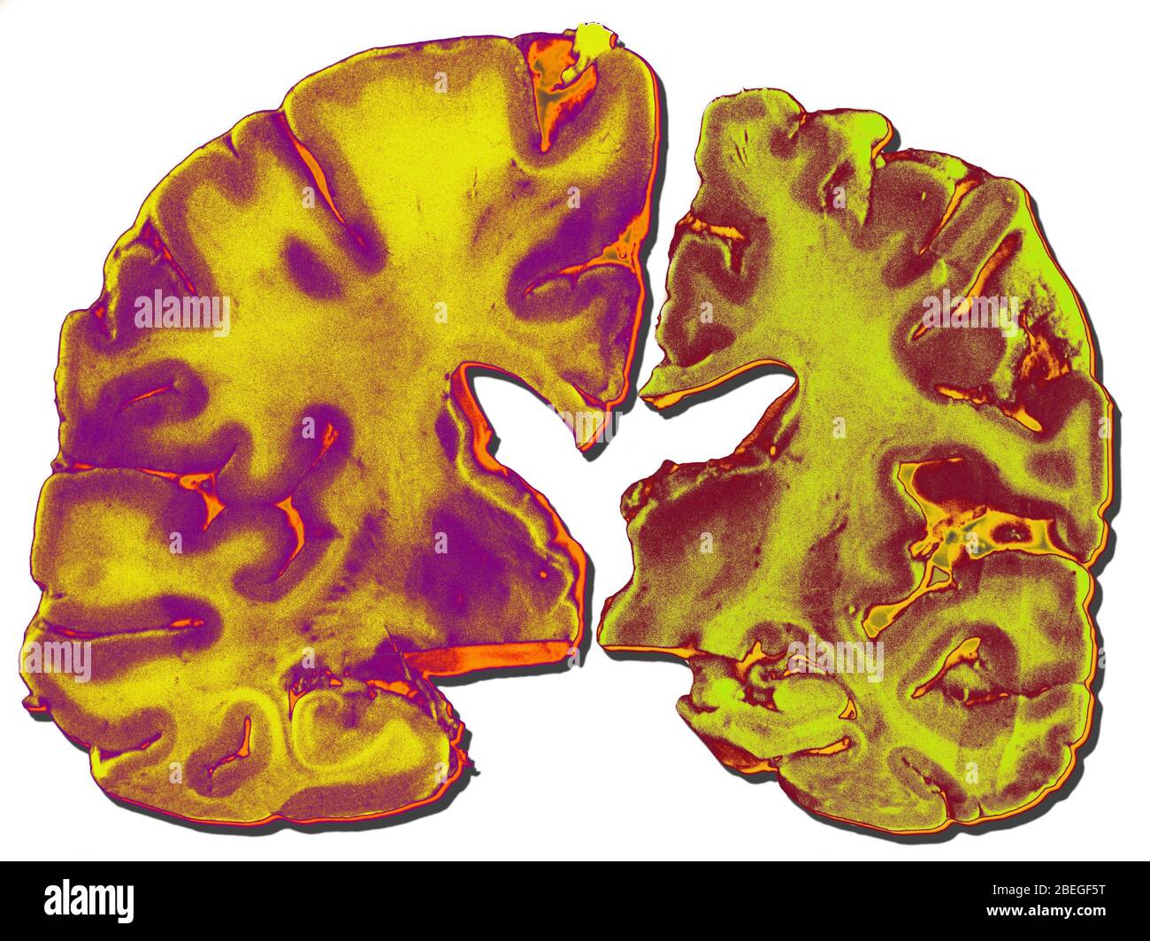 Alzheimer's Disease Stock Photo