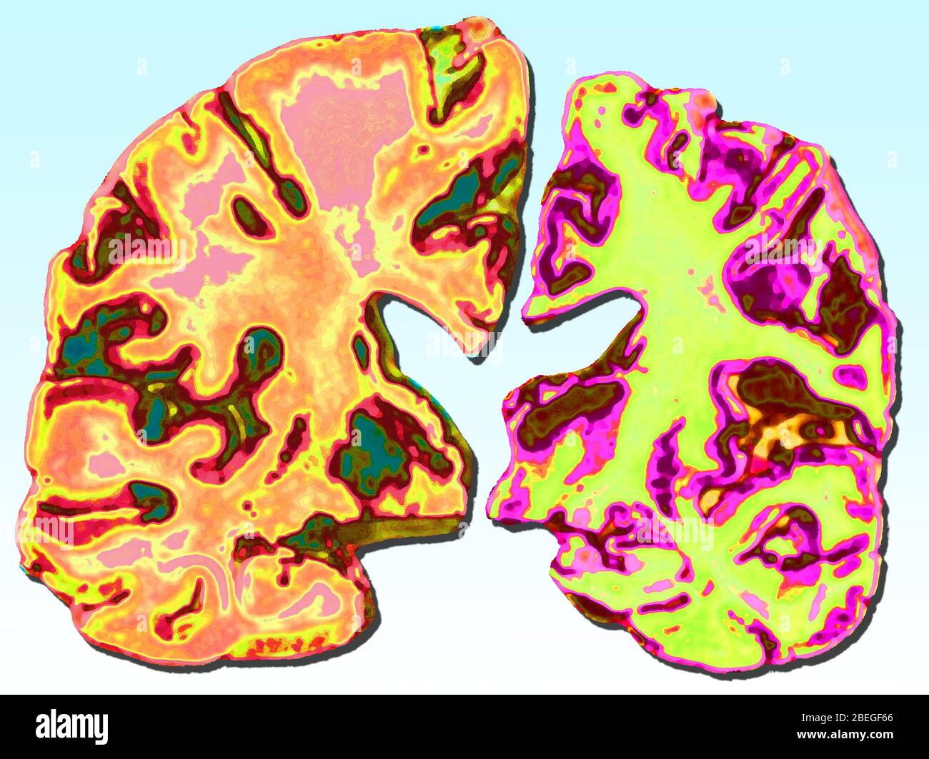 Alzheimer's Disease Stock Photo