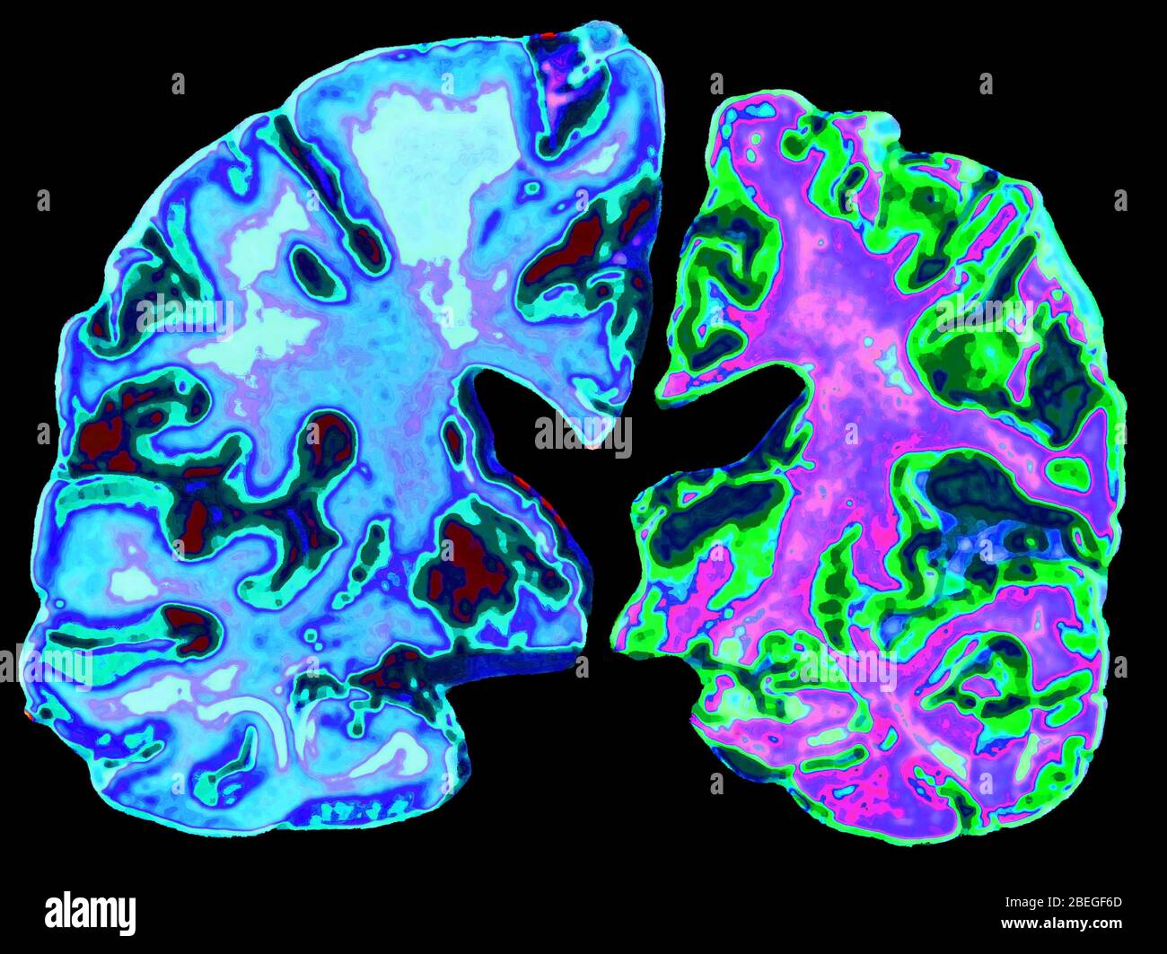 Normal and alzheimer disease brain hi-res stock photography and images ...