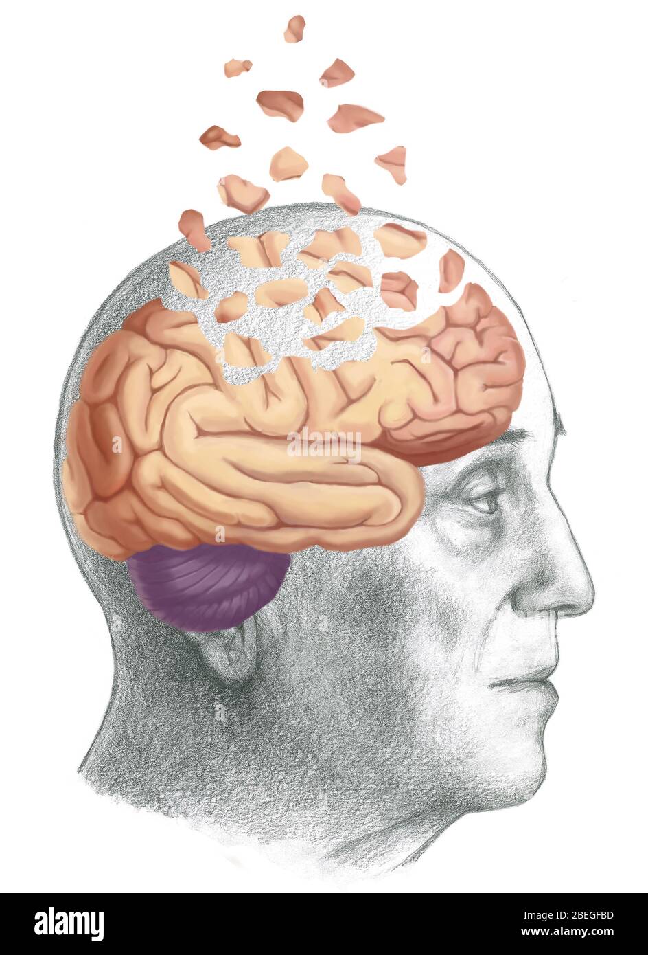 Alzheimer's Stock Photo