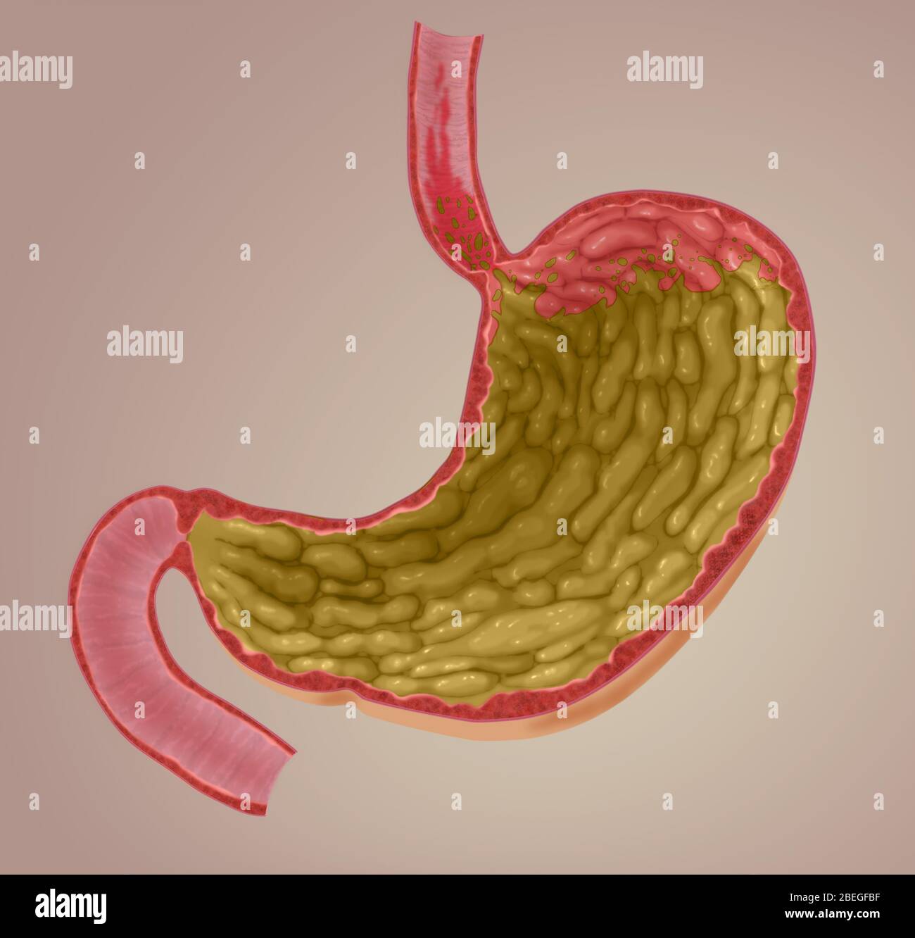 Illustration of Acid Reflux Stock Photo Alamy