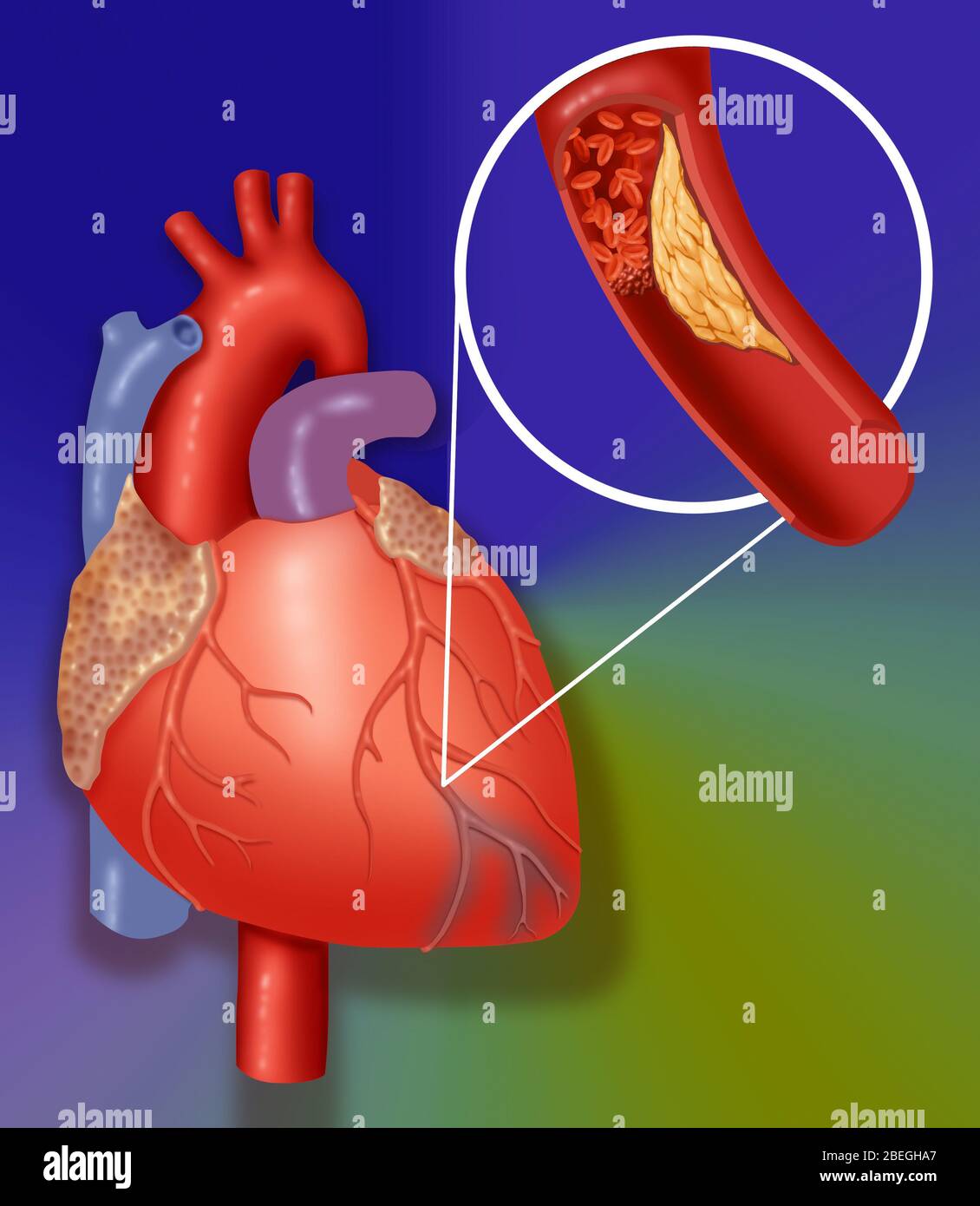 Heart Attack Showing Blood Clot Stock Photo - Alamy