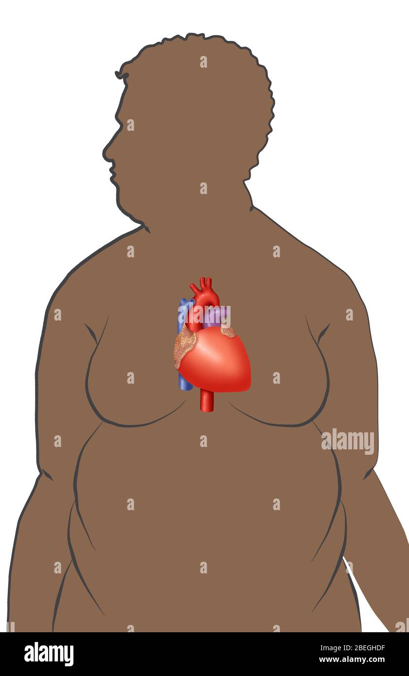Obesity increases the risk of heart disease Stock Photo