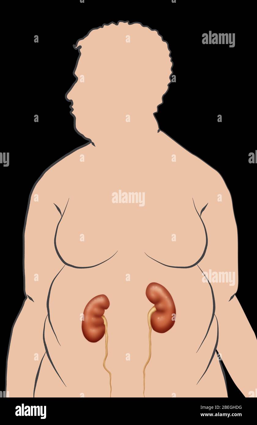 Obesity increases the risk of renal disease Stock Photo