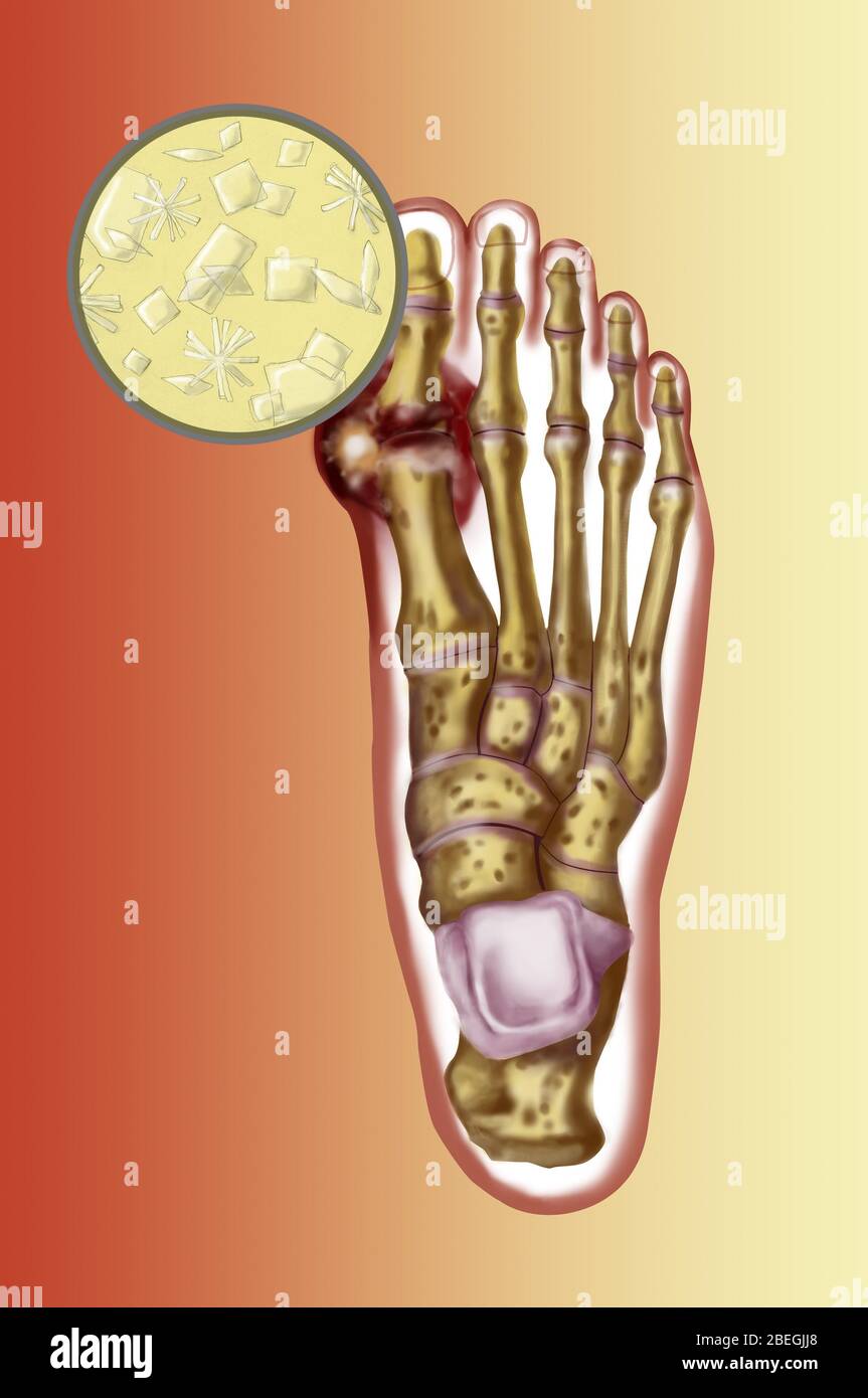 Foot with gout Stock Photo