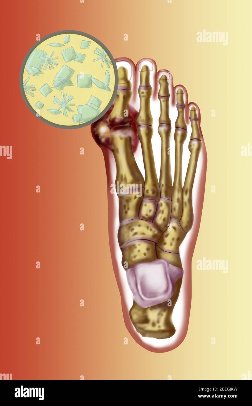 Foot with gout Stock Photo Alamy