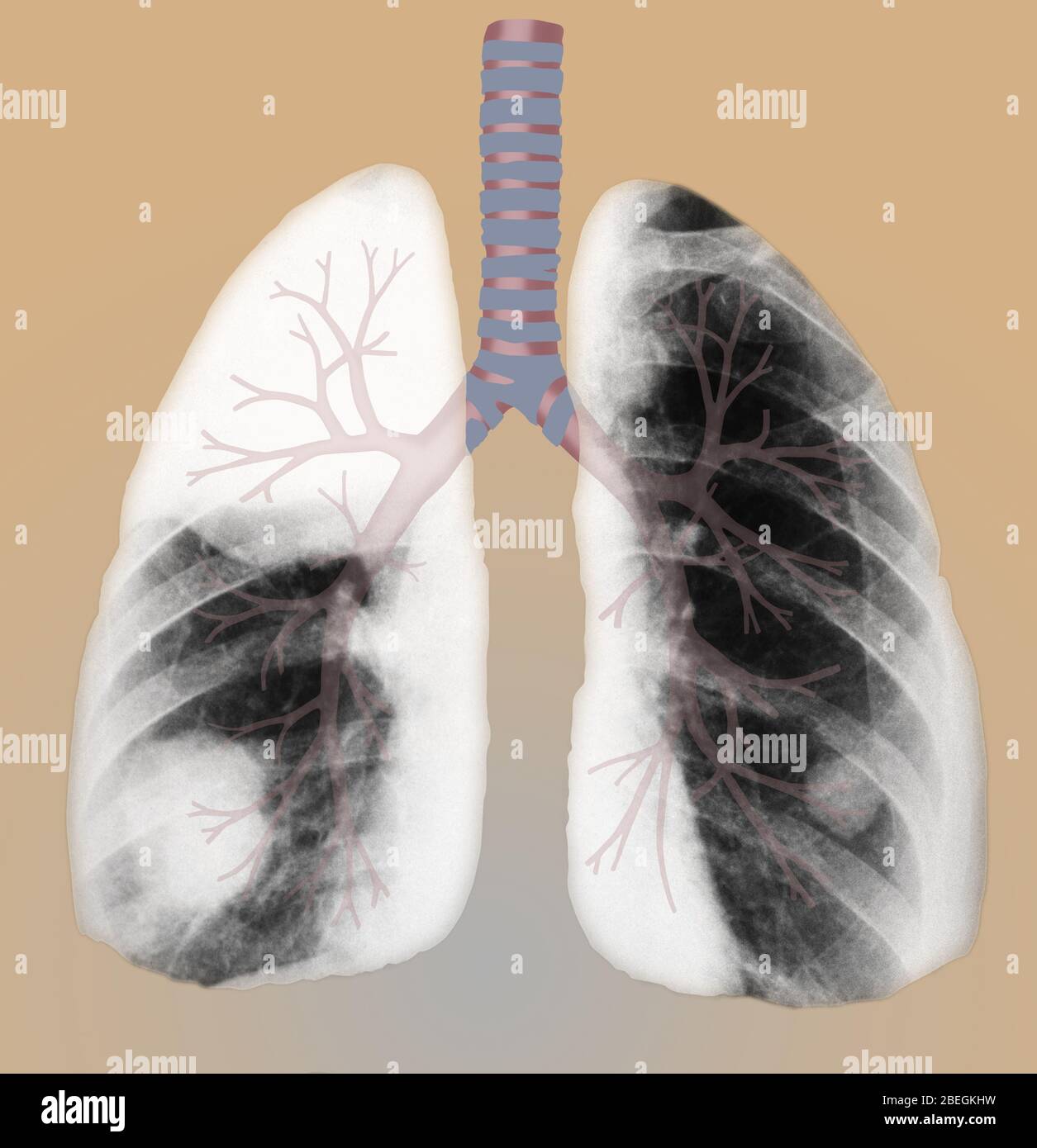 Bronchial Tubes High Resolution Stock Photography and Images Alamy