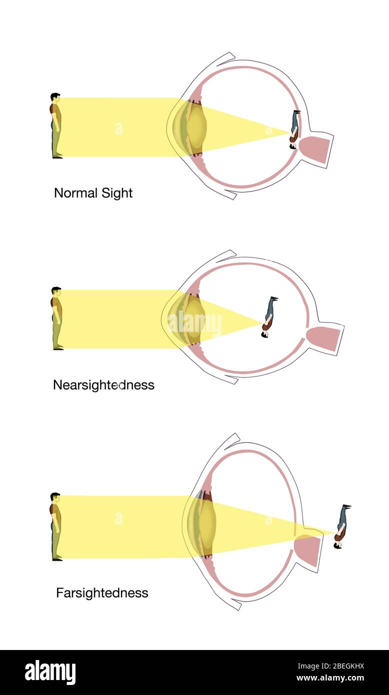 Normal Nearsighted And Farsighted Vision Stock Photo Alamy Normal Nearsighted And Farsighted Vision Stock Photo Alamy