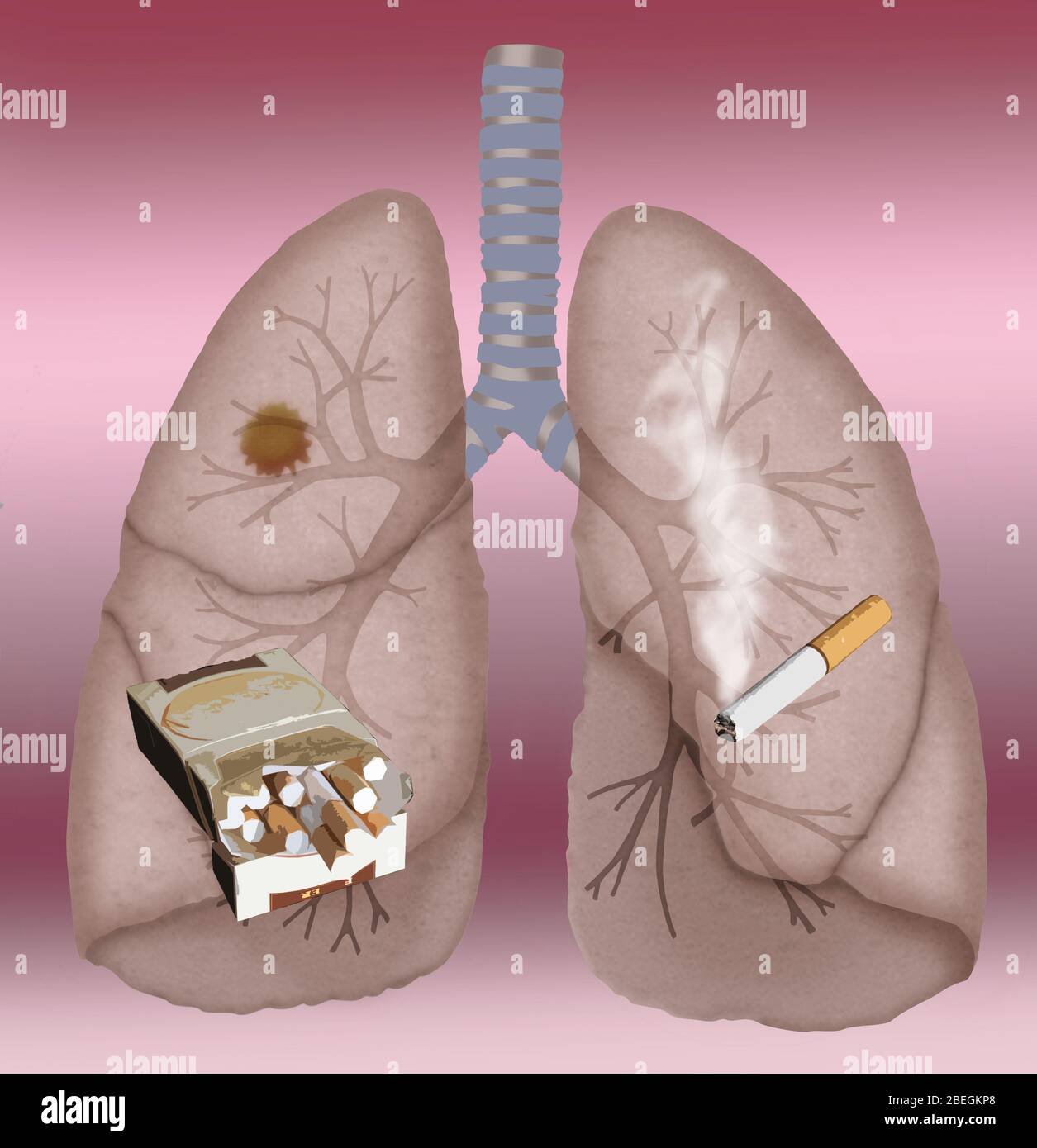 Lung Cancer Stock Photo