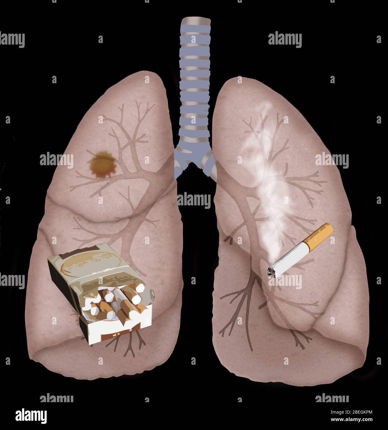 Lung Cancer Stock Photo