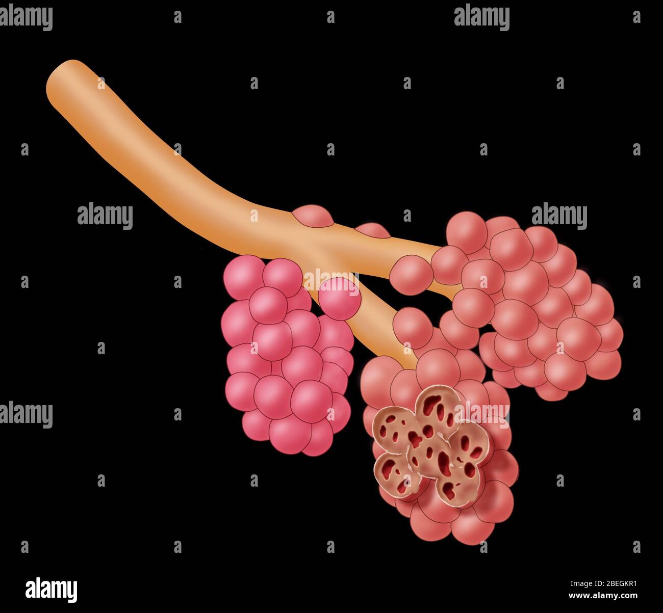 Alveoli Damaged By Emphysema Stock Photo - Alamy