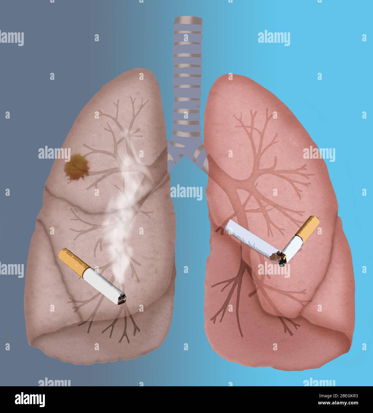 Healthy and Cancerous Lungs Stock Photo