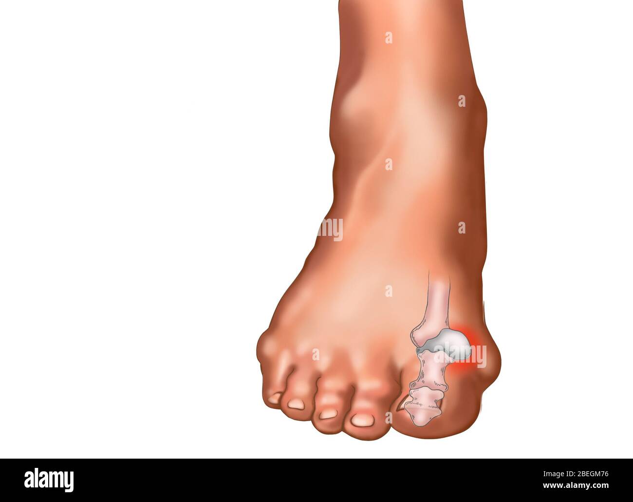 Understanding the Difference: Normal Foot vs. A Bunion - Luxe Foot