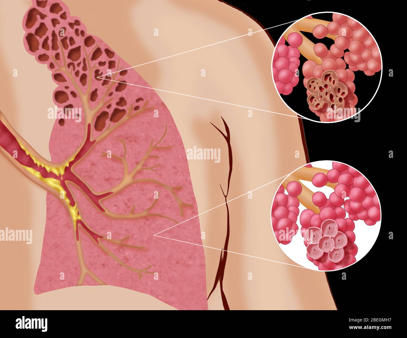Emphysema Stock Photo Alamy