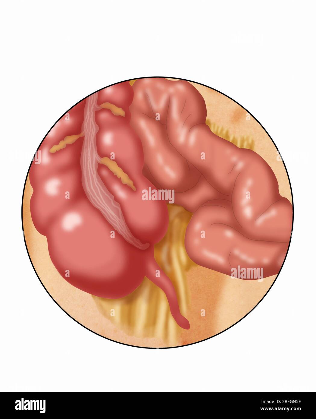 Normal appendix illustration Cut Out Stock Images & Pictures - Alamy