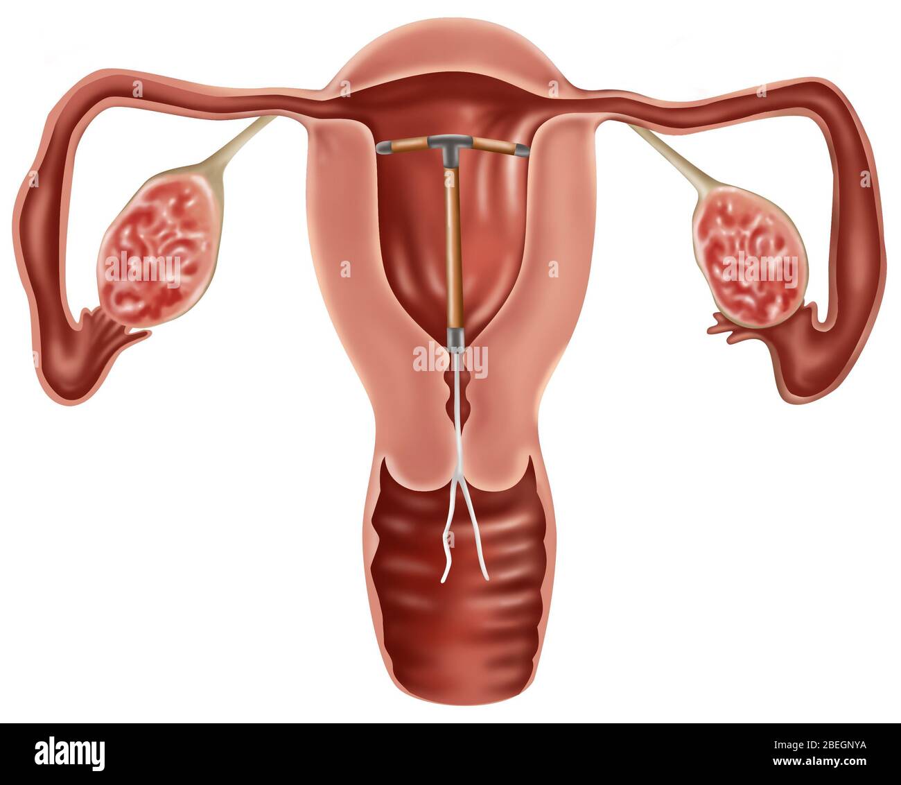 Iud birth control hi-res stock photography and images - Alamy