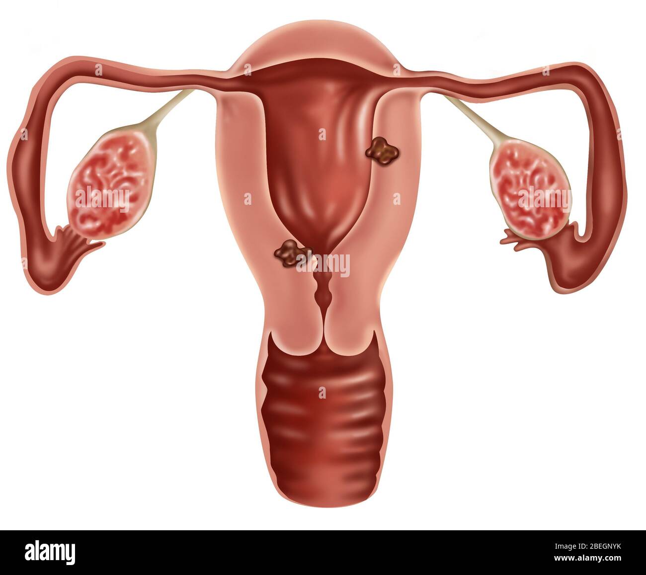 Endometrial Cancer Stock Photo