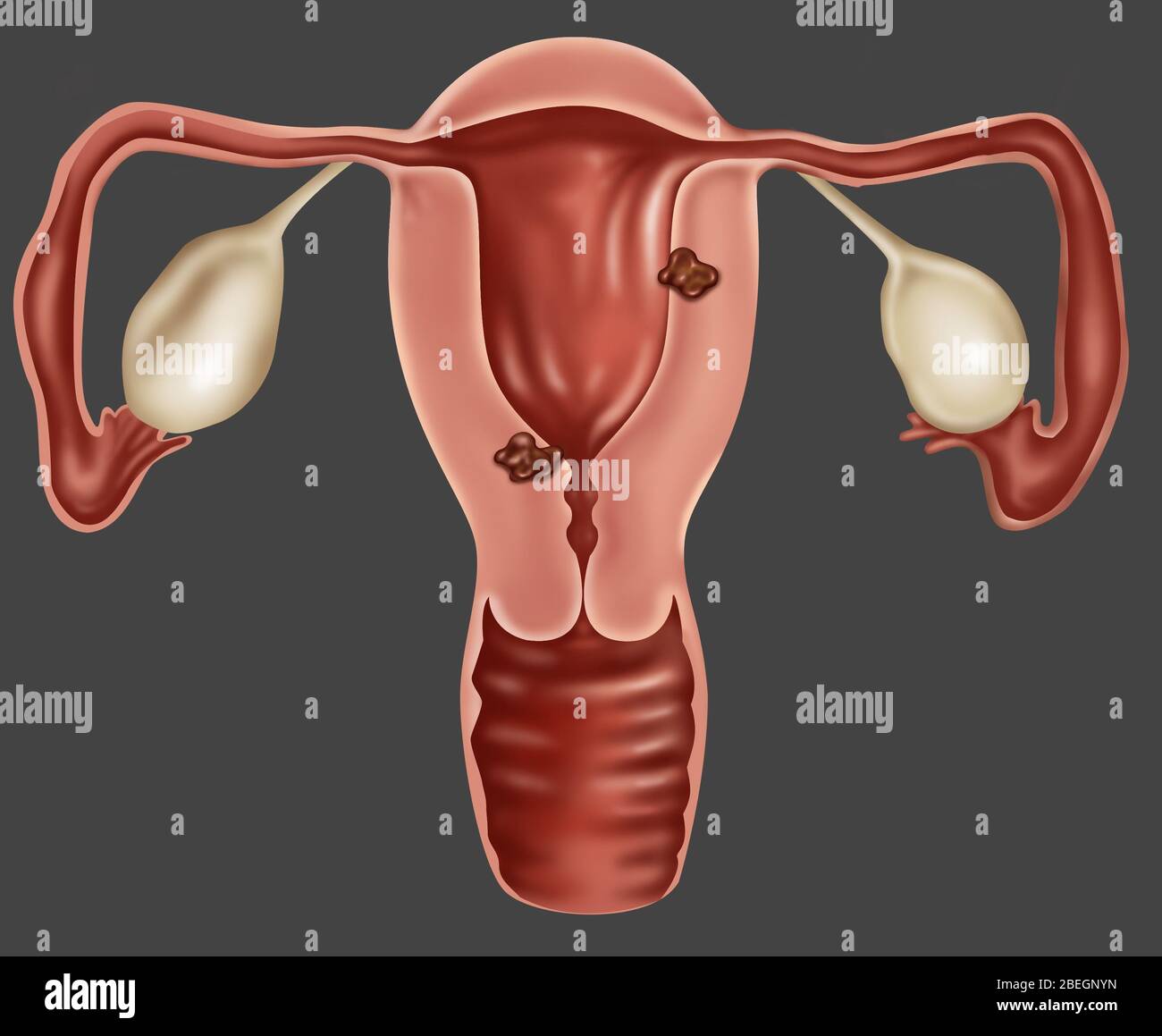 Endometrial Cancer Stock Photo
