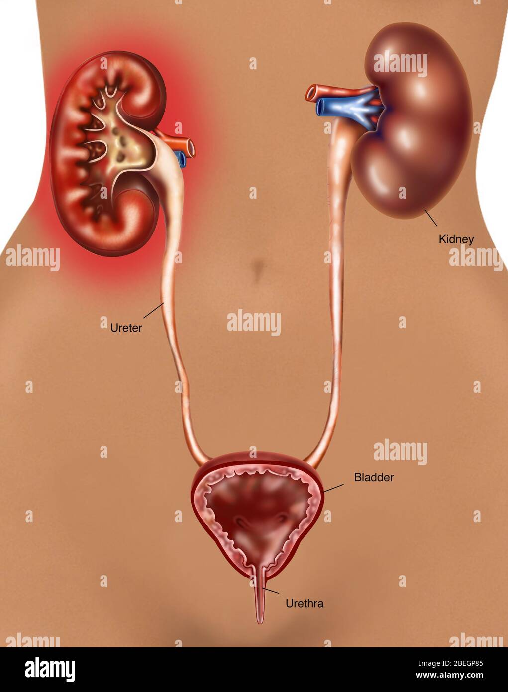 Pyelonephritis (Kidney Infection) Stock Photo