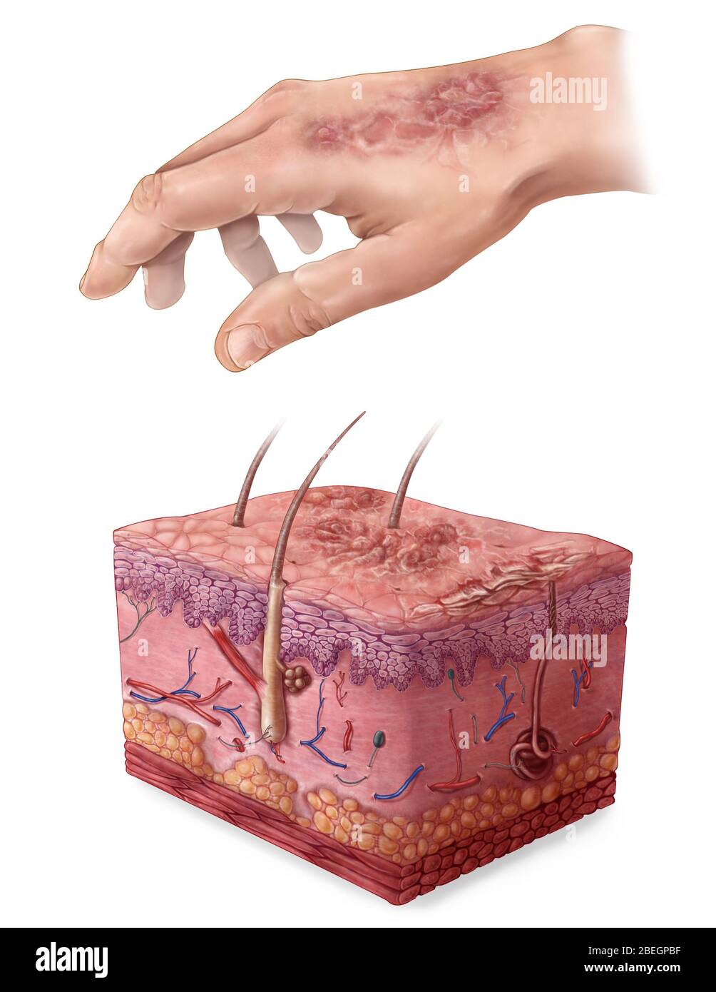 Section of skin with psoriasis hi-res stock photography and images - Alamy