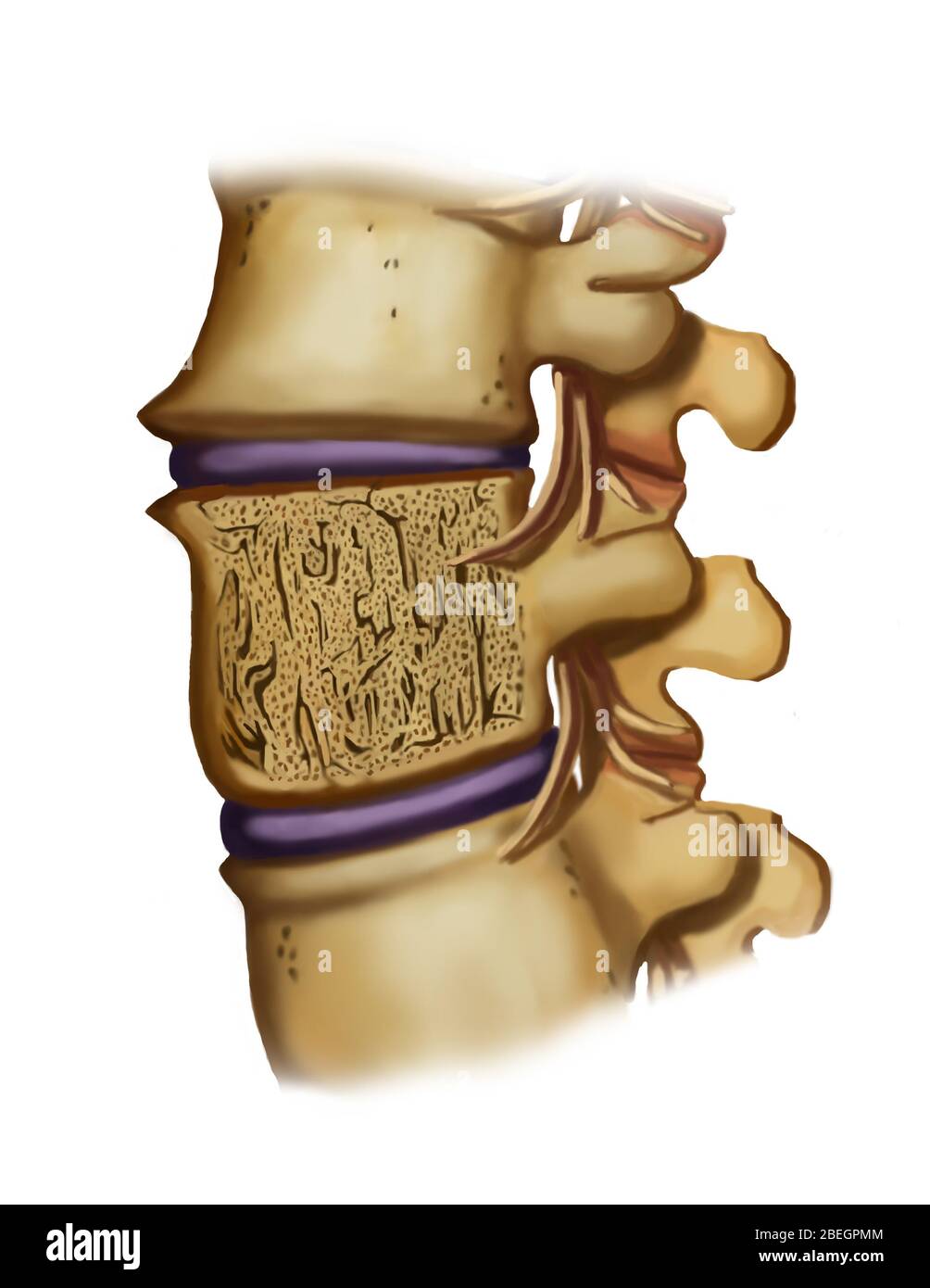 Osteoporosis Fracture in Spine Stock Photo