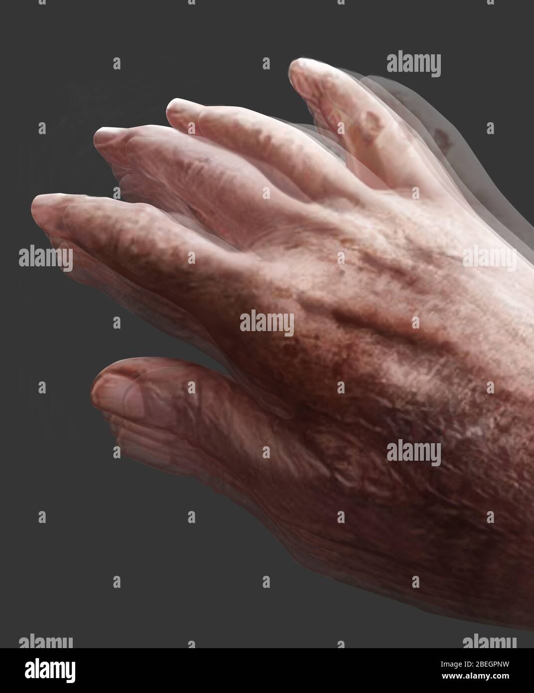 Parkinson's Disease Stock Photo