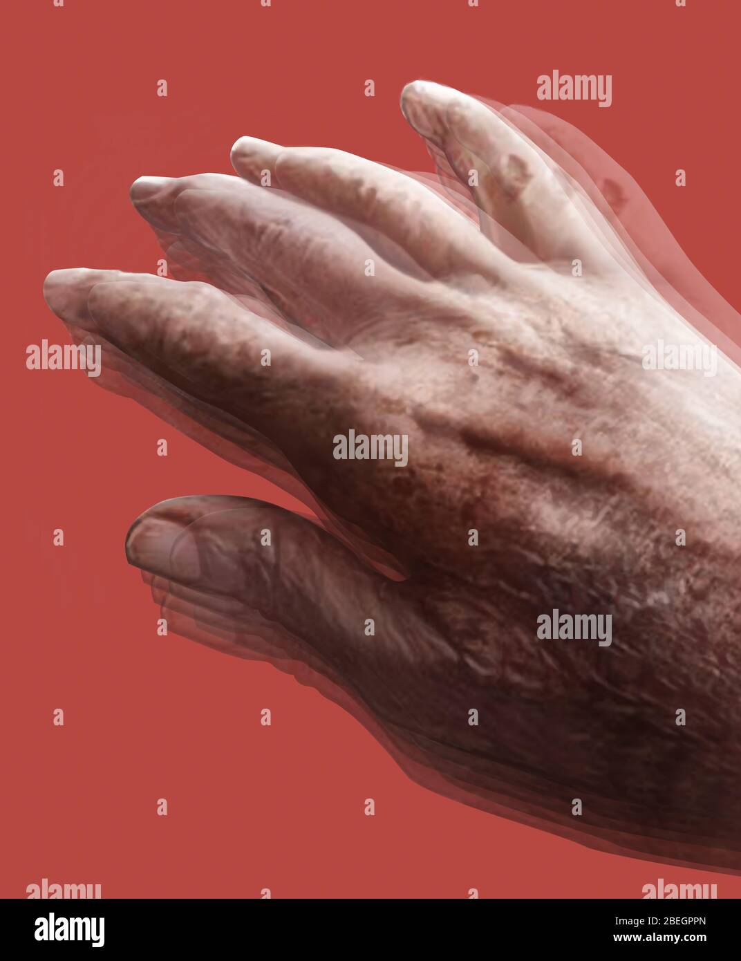 Parkinson's Disease Stock Photo