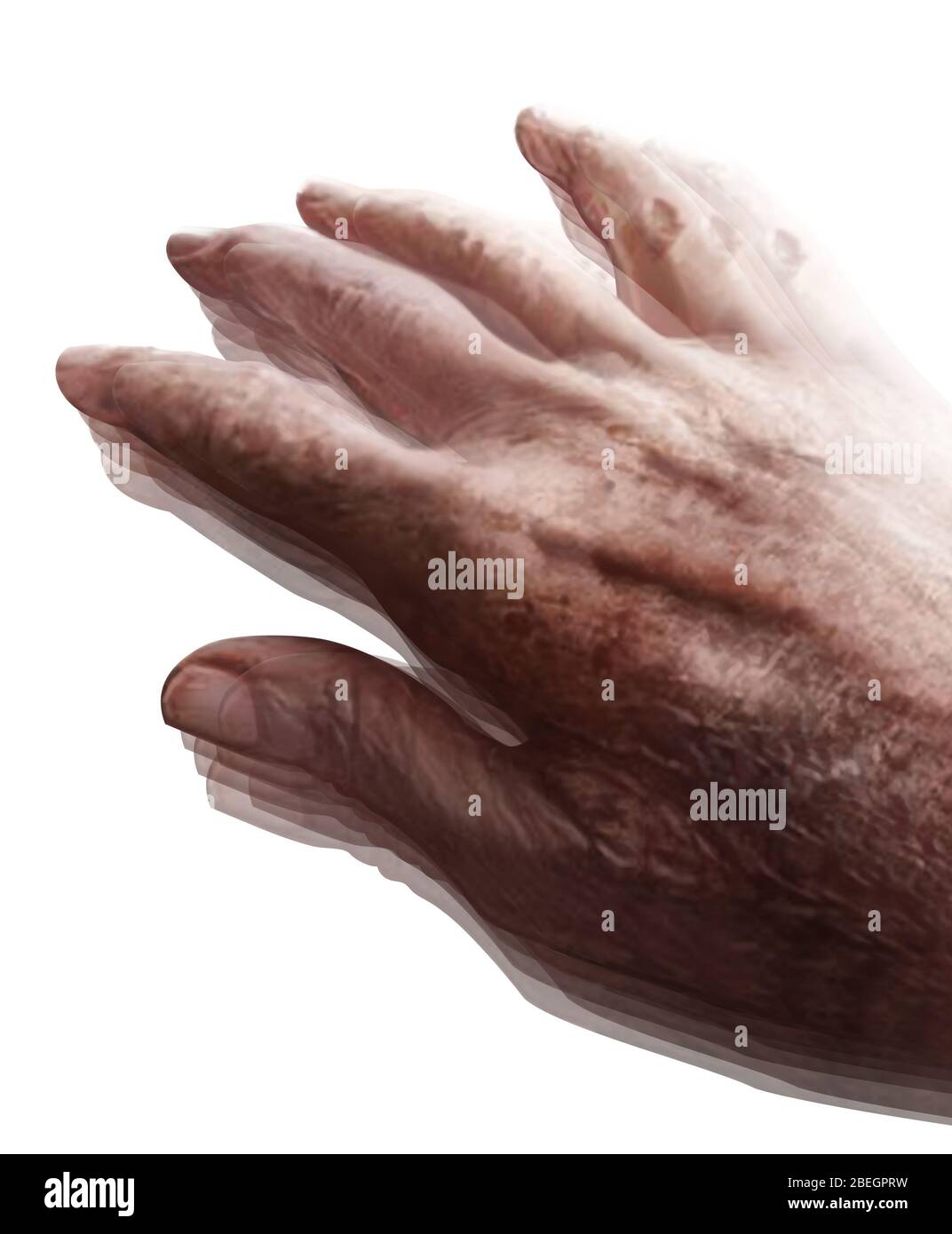 Parkinson's Disease Stock Photo