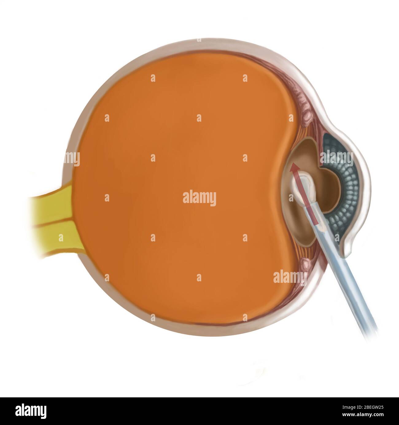 Lens Replacement Surgery Stock Photo Alamy